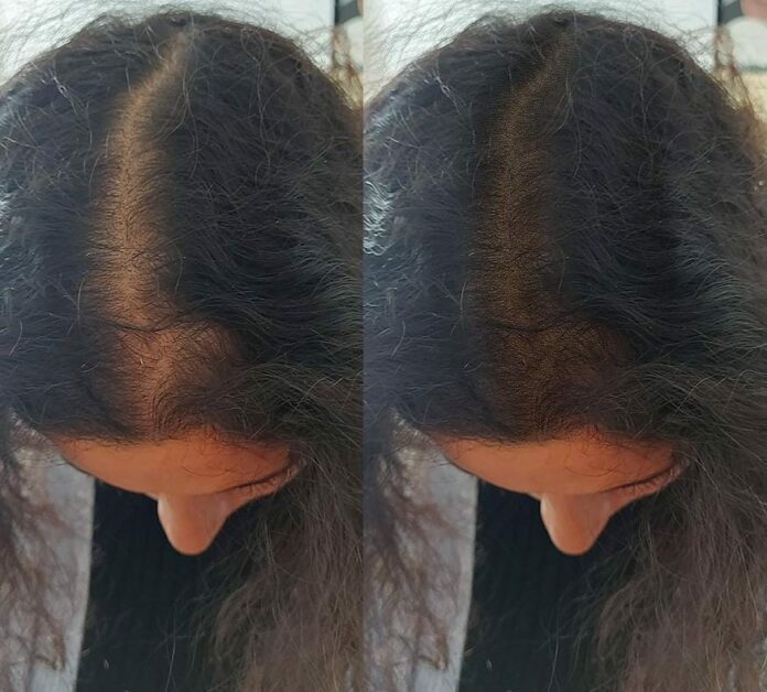 Clinique de la Tricopigmentation